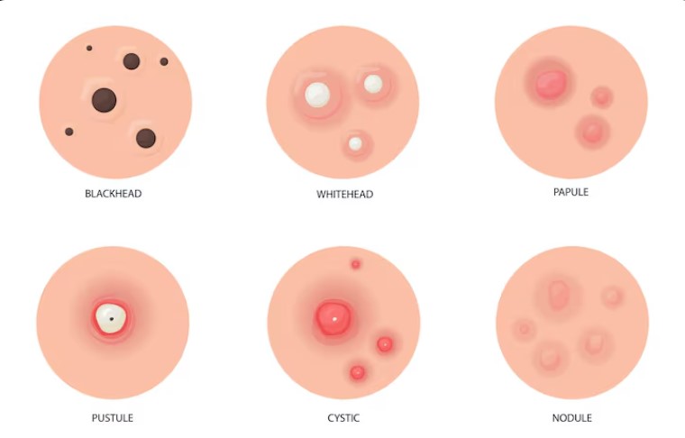 Best Pimple Treatment in Sangamner